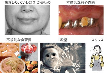 歯周病を進行させる因子の例
