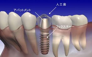 インプラントの各部名称