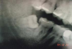 智歯が手前の歯の歯根部に食い込み、大きなむし歯をつくったレントゲン写真