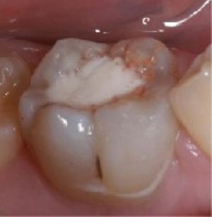 ドックスベストセメント塗布前の写真３