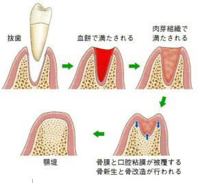 抜歯後の様子